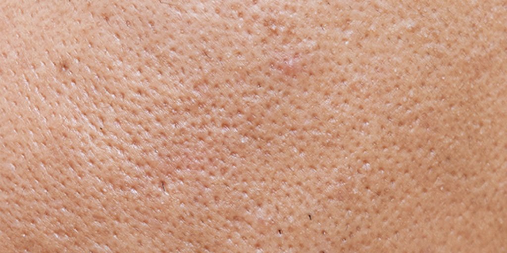 Face blackheads hotsell