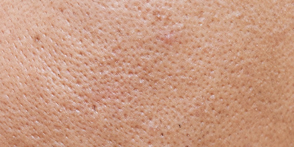 Acne Article - main image