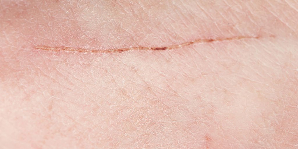 Burnt skin : causes, treatments, products by La Roche-Posay