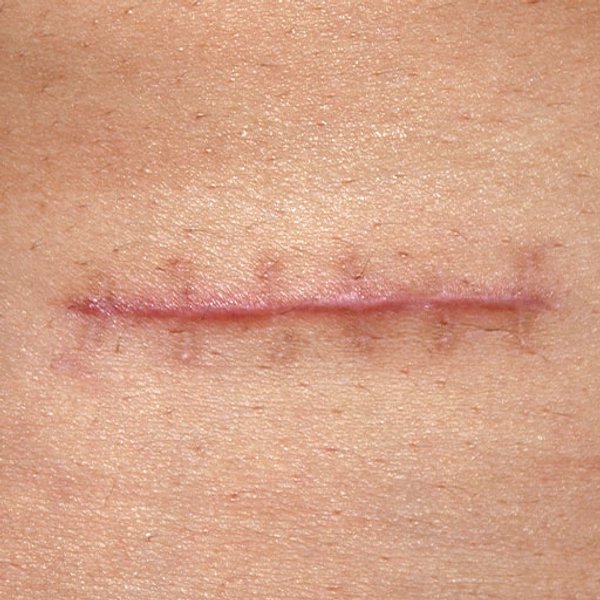 Stitches Scar Stitches Scar