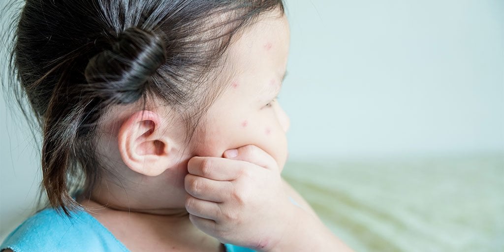 baby eczema head scratching